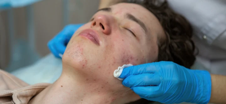 Acne Management, Including Roaccutane Therapy