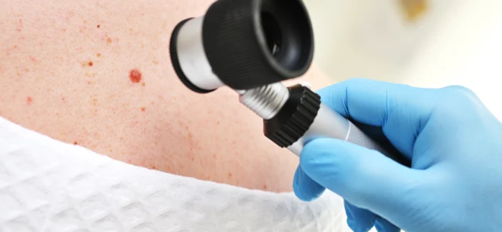 Skin Cancer Excisions Skin Cancer Excisions